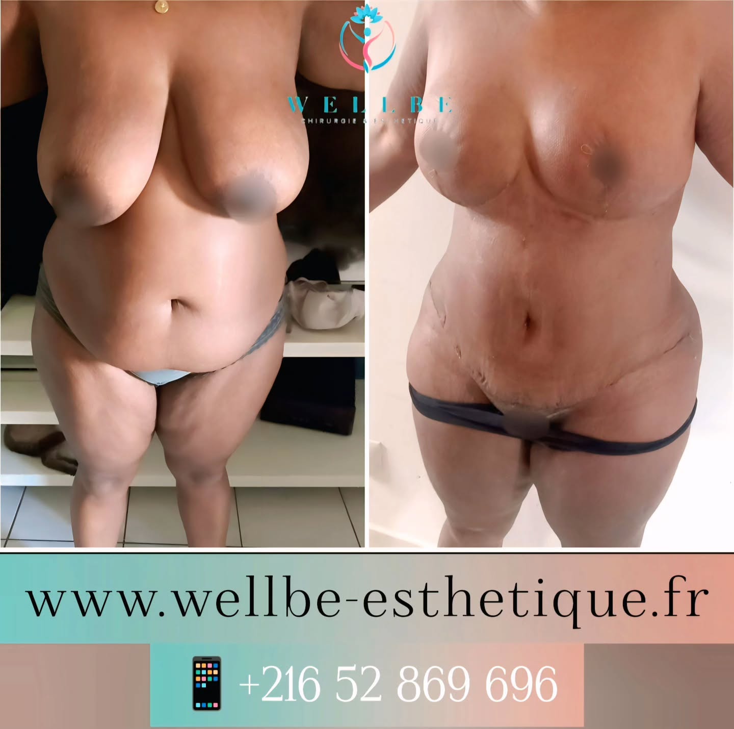 Résultat IMMÉDIAT 🔥 Réduction mammaire avec Lifting + Liposuccion plusieurs zones avec Abdominoplastie + BBL 🔥
————————————————————————
☎️Contactez-nous pour un Devis gratuit et personnalisé
WhatsApp 📲 + 216 52 869 696
📧 devis@wellbe-esthetique.fr
https://wellbe-esthetique.fr/
-————————————————————————
#chirurgieesthetique #plasticsurgery #chirurgieplastique #medecineesthetique #chirurgienesthetique #augmentationmammaire #rhinoplastie #liposuccion #tummytuck #bbl #facelift #botox #fillers #acidehyaluronique #avantapres #transformation #beauty #aesthetic #cosmeticsurgery #beforeandafter #plasticsurgeon #chirurgienplasticien #chirurgieesthetiqueparis #tunisie #paris #france#wellbechirurgieesthetique#wellbetunisie#wellbe