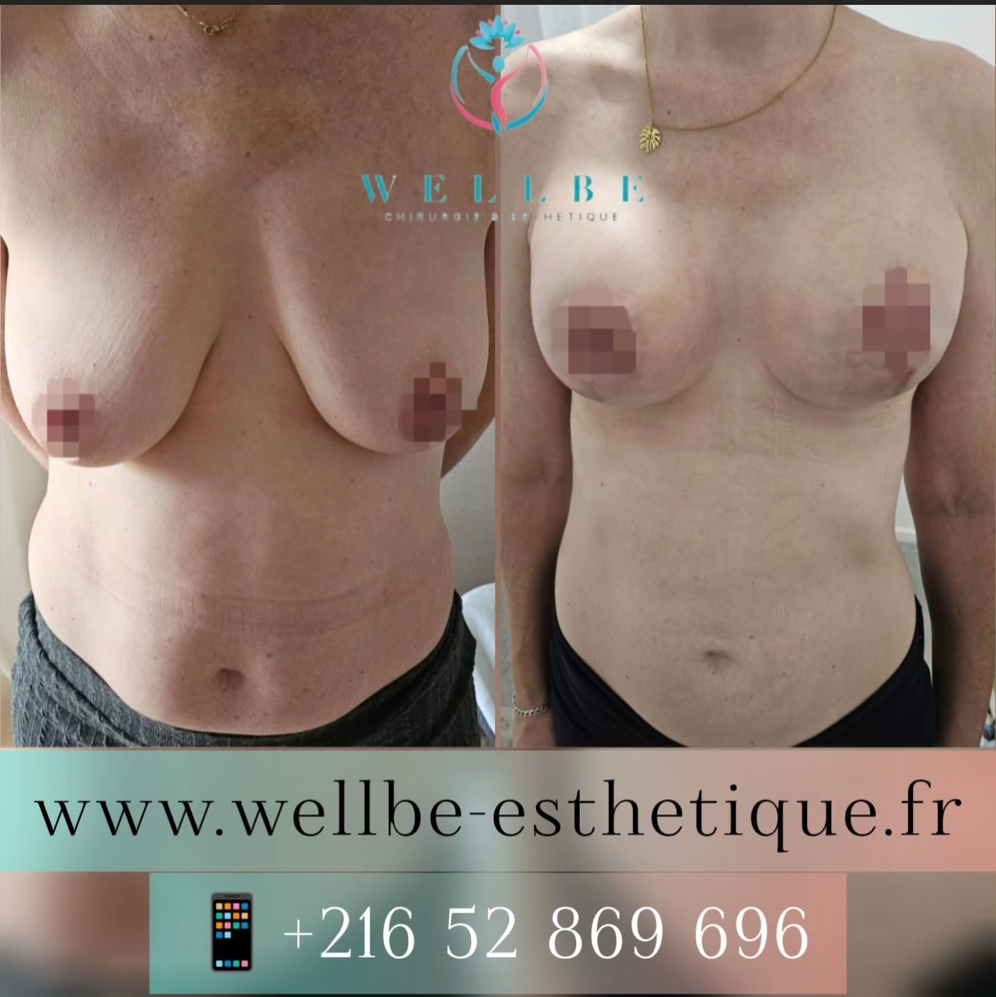 Résultat IMMÉDIAT 🔥Lifting mammaire avec prothèses 🔥
————————————————————————
☎️Contactez-nous pour un Devis gratuit et personnalisé
WhatsApp 📲 + 216 52 869 696
📧 devis@wellbe-esthetique.fr
https://wellbe-esthetique.fr/
-————————————————————————
#chirurgieesthetique #plasticsurgery #chirurgieplastique #medecineesthetique #chirurgienesthetique #augmentationmammaire #rhinoplastie #liposuccion #tummytuck #bbl #facelift #botox #fillers #acidehyaluronique #avantapres #transformation #beauty #aesthetic #cosmeticsurgery #beforeandafter #plasticsurgeon #chirurgienplasticien #chirurgieesthetiqueparis #tunisie #paris #france#wellbechirurgieesthetique#wellbetunisie#wellbe
