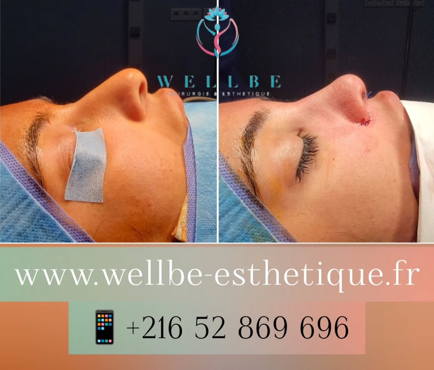 Résultat IMMÉDIAT 🔥 Rhinoplastie 🔥
————————————————————————
☎️Contactez-nous pour un Devis gratuit et personnalisé
WhatsApp 📲 + 216 52 869 696
📧 devis@wellbe-esthetique.fr
https://wellbe-esthetique.fr/
-————————————————————————
#chirurgieesthetique #plasticsurgery #chirurgieplastique #medecineesthetique #chirurgienesthetique #augmentationmammaire #rhinoplastie #liposuccion #tummytuck #bbl #facelift #botox #fillers #acidehyaluronique #avantapres #transformation #beauty #aesthetic #cosmeticsurgery #beforeandafter #plasticsurgeon #chirurgienplasticien #chirurgieesthetiqueparis #tunisie #paris #france#wellbechirurgieesthetique#wellbetunisie#wellbe