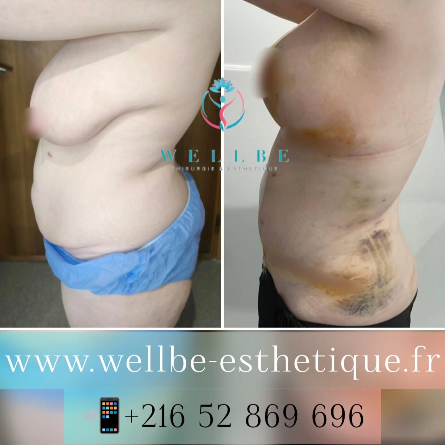 Résultat immédiat 🔥Abdominoplastie + Lifting mammaire 🔥
————————————————————————
☎️Contactez-nous pour un Devis gratuit et personnalisé
WhatsApp 📲 + 216 52 869 696
📧 devis@wellbe-esthetique.fr
https://wellbe-esthetique.fr/
-————————————————————————
#chirurgieesthetique #plasticsurgery #chirurgieplastique #medecineesthetique #chirurgienesthetique #augmentationmammaire #rhinoplastie #liposuccion #tummytuck #bbl #facelift #botox #fillers #acidehyaluronique #avantapres #transformation #beauty #aesthetic #cosmeticsurgery #beforeandafter #plasticsurgeon #chirurgienplasticien #chirurgieesthetiqueparis #tunisie #paris #france#wellbechirurgieesthetique#wellbetunisie#wellbe