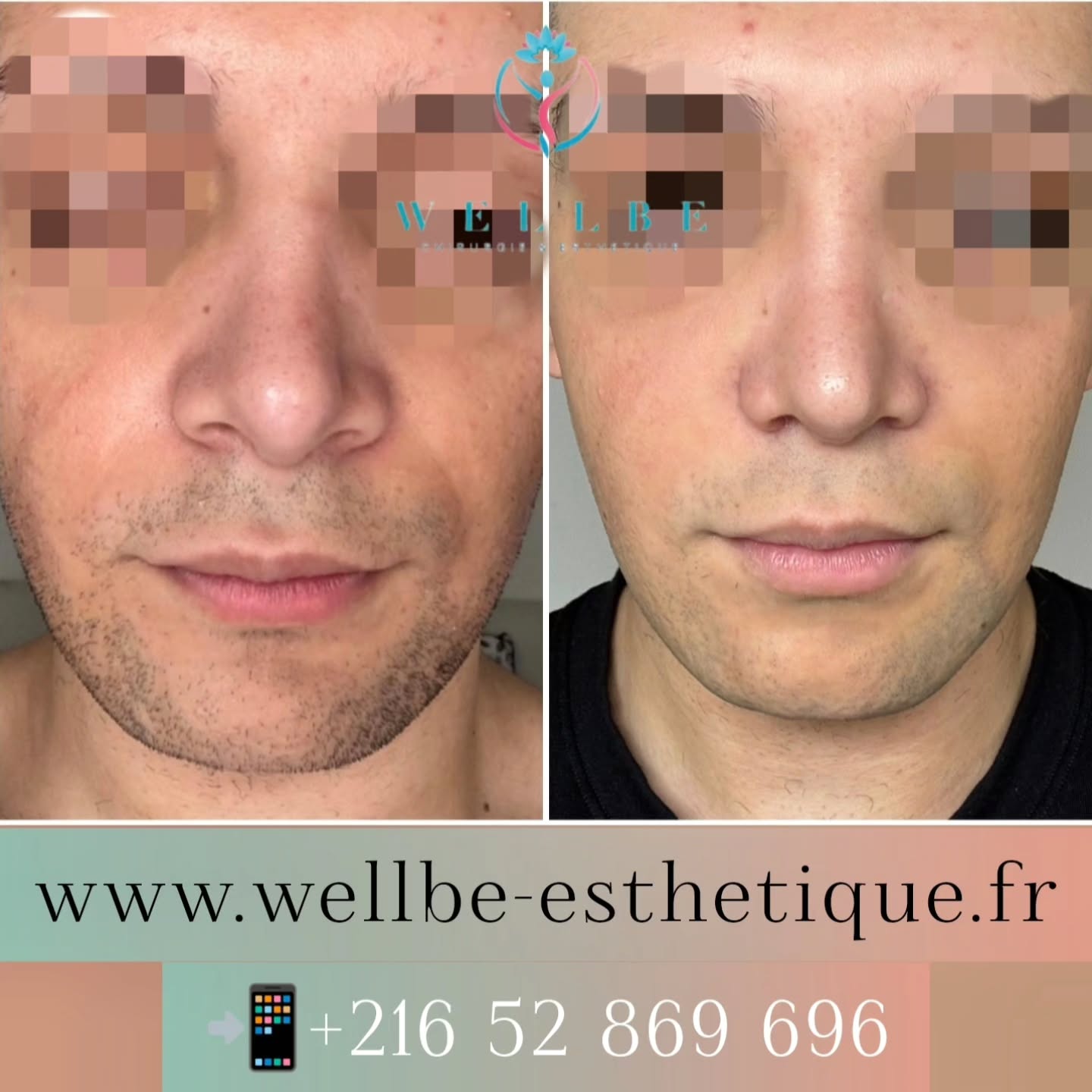 Résultat immédiat 🔥 Rhinoplastie Secondaire 🔥
————————————————————————
☎️Contactez-nous pour un Devis gratuit et personnalisé
WhatsApp 📲 + 216 52 869 696
📧 devis@wellbe-esthetique.fr
https://wellbe-esthetique.fr/
-————————————————————————
#chirurgieesthetique #plasticsurgery #chirurgieplastique #medecineesthetique #chirurgienesthetique #augmentationmammaire #rhinoplastie #liposuccion #tummytuck #bbl #facelift #botox #fillers #acidehyaluronique #avantapres #transformation #beauty #aesthetic #cosmeticsurgery #beforeandafter #plasticsurgeon #chirurgienplasticien #chirurgieesthetiqueparis #tunisie #paris #france#wellbechirurgieesthetique#wellbetunisie#wellbe