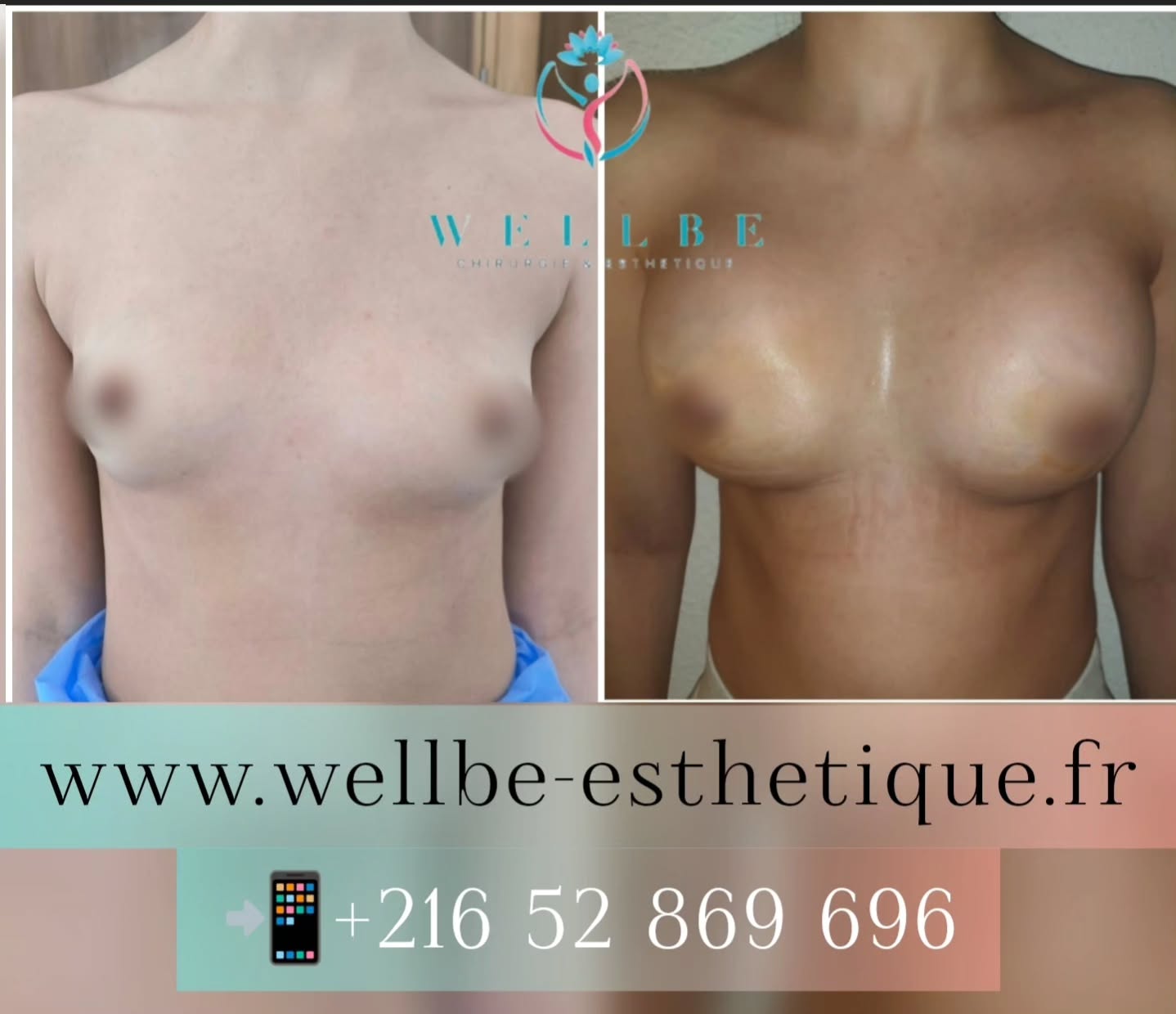 Résultat immédiat 🔥 Augmentation mammaire par prothèses 🔥
————————————————————————
☎️Contactez-nous pour un Devis gratuit et personnalisé
WhatsApp 📲 + 216 52 869 696
📧 devis@wellbe-esthetique.fr
https://wellbe-esthetique.fr/
-————————————————————————
#chirurgieesthetique #plasticsurgery #chirurgieplastique #medecineesthetique #chirurgienesthetique #augmentationmammaire #rhinoplastie #liposuccion #tummytuck #bbl #facelift #botox #fillers #acidehyaluronique #avantapres #transformation #beauty #aesthetic #cosmeticsurgery #beforeandafter #plasticsurgeon #chirurgienplasticien #chirurgieesthetiqueparis #tunisie #paris #france#wellbechirurgieesthetique#wellbetunisie#wellbe