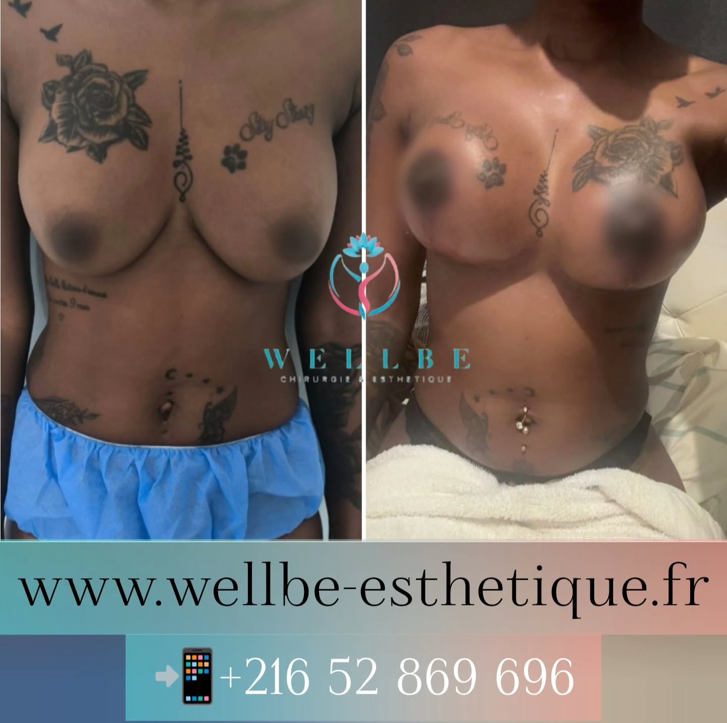 Résultat immédiat 🔥 Lifting mammaire avec prothèses 🔥
————————————————————————
☎️Contactez-nous pour un Devis gratuit et personnalisé
WhatsApp 📲 + 216 52 869 696
📧 devis@wellbe-esthetique.fr
https://wellbe-esthetique.fr/
-————————————————————————
#chirurgieesthetique #plasticsurgery #chirurgieplastique #medecineesthetique #chirurgienesthetique #augmentationmammaire #rhinoplastie #liposuccion #tummytuck #bbl #facelift #botox #fillers #acidehyaluronique #avantapres #transformation #beauty #aesthetic #cosmeticsurgery #beforeandafter #plasticsurgeon #chirurgienplasticien #chirurgieesthetiqueparis #tunisie #paris #france#wellbechirurgieesthetique#wellbetunisie#wellbe