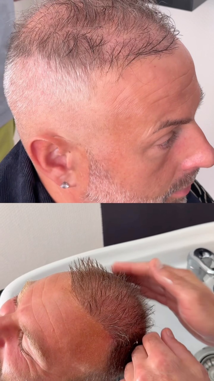 Vous les reconnaissez ? 👀
Il y a quelques semaines, je vous partageais leur témoignage juste après leur greffe de cheveux à Strasbourg.
Aujourd’hui, les voici à J + 4 mois. 🌱
Bien sûr, ce n’est pas la première fois que je les revois depuis leur intervention. Pendant toute la période post-greffe, nous nous retrouvons régulièrement pour suivre l’évolution, réaliser des soins adaptés à chaque étape et répondre à toutes leurs questions.
Même si ces deux patients avaient déjà vécu une première greffe de cheveux auparavant, chaque intervention est différente. Il est donc essentiel de les accompagner, de les rassurer lorsque c’est nécessaire et d’adapter les soins en fonction de l’évolution de leur cuir chevelu et de leurs cheveux.
À J + 4 mois, l’objectif est d’accompagner la repousse avec des soins ciblés tout en faisant le point sur les progrès déjà visibles.
Mon rôle ne s’arrête pas le jour de la greffe. Mon engagement, c’est de rester à vos côtés tout au long de votre parcours capillaire, jusqu’au résultat final.
Une question sur la greffe de cheveux ou sur le suivi post-opératoire ? Je serai ravi d’y répondre en commentaire ou en message privé.
#GreffeDeCheveux #GreffeCheveuxStrasbourg #ExpertCapillaire #SuiviPostGreffe #SébastienGillmann